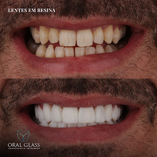 facetas_em_resina.25.2 1