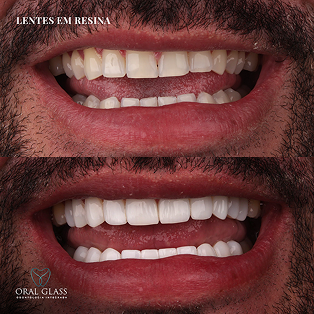 facetas_em_resina_72.3 1