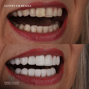 facetas_em_resina_73 1