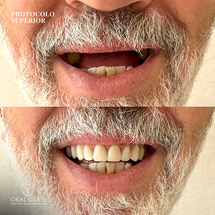 facetas_em_resina_78 1